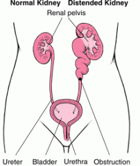 -Distention/dilation of the kidneys caused by backward pressure from obstructed flow.