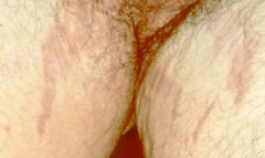name for:

Thinning of the skin (epidermis or dermis)

any circumbscribed loss of epidermis or dermis - a scar is a type
