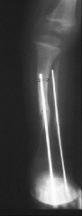 Anterolateral tibial bowing and congenital pseudoarthrosis of the tibia are related conditions and represent a continuum of the same disease process. It is most commonly seen in children with neurofibromatosis. The radiograph in Illustration A is ...