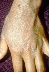 name for:

Thick texture
from rubbing skin

hallmark lesion of ectopic dermatitis
(*exam question)