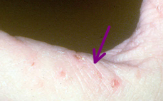 name for:

Scale lines

from scabies - from human mite 

Burrows into top layer of epidermis (stratum corneum)