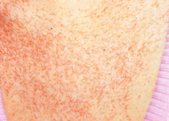 name for:

Circumscribed macules
blanch when pressed


Blood vessels - just more pronounced