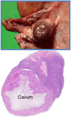 collapse of mature follicle after ovulation
corpus hemorrhagicum-- hemorrhage into follicle, develops into corpus luteum


if fertilized, corpus luteum persists and secretes progesterone and estrogen
if not, produces progesterone but within 12 day...