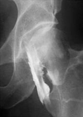 Snapping Hip (Coxa Saltans)iliopsoas tendon sliding over
femoral head 
prominent iliopectineal ridge 
exostoses of lesser trochanter
iliopsoas bursaUltrasounddynamic study which may demonstrate the snapping band in either internal or external snap...