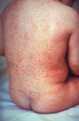 widespread rash usually in children