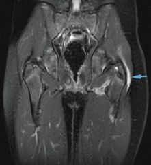 Trochanteric Bursitis
MRI will show increased signal in bursa due to inflammation on T2 sequence
open vs arthroscopic trochanteric bursectomy  