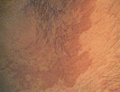 type of plaque

Brown to red
patches
in the groin
from - Corynebacterium minutissimum (normal skin flora)

Predisposing factors
	- ↑ sweating
	- Obesity
	- DM