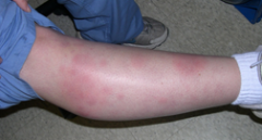 Hypersensitivity reaction
		b. Inflammatory response of dermis - fat
		c. Not painful
			i. Hot / red then bluish/yellow
		d. Discrete nodules
		e. 1-2 wks - then desquamate
		f. Usually
			i. Lower legs
			ii. Can be on arms / face
		g. ...