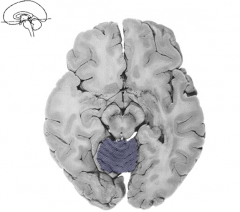 What type of section is this?

What is the purple structure in the post 3rd of the brain?
