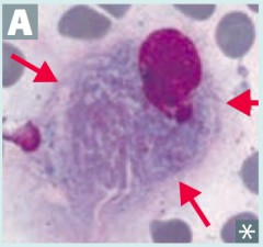 What is the most common lysosomal storage disorder, causing hepatosplenomegaly, pancytopenia, aseptic necrosis of femur, bone crises, and lipid-laden macrophages (picture)? Cause?