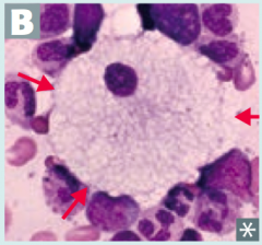 Which disease presents with progressive neurodgeneration, hepatosplenomegaly, cherry red spot on macula, and foam cells (lipid-laden macrophages (picture)? Cause?