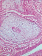 Which disease presents with progressive neurodegeneration, developmental delay, cherry red spot on macula, lysosomes with onion skin (picture), and NO hepatosplenomegaly? Cause?