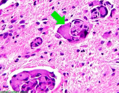 Which disease presents with peripheral neuropathy, developmental delay, optic atrophy, and globoid cell (picture)? Cause?