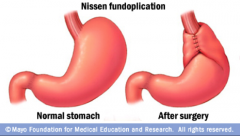 A nissen fundoplication 
Fundus of the stomach is wrapped around the intra-abdominal oesophagus