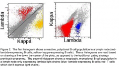 Admixture of kappa and lambda expressing B cells and CD4(+) and CD8(+) T cells