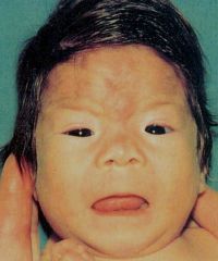 microcephaly, maxillary hypoplasia, short palpebral fissures, joint abnormalities, and cardiovascular defects are characteristics of...