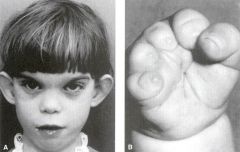 _______________ causes “fetal hydantoin syndrome,” which includes IUGR, microcephaly, ptosis, nail and/or distal phalangeal hypoplasia.