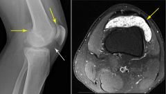 synovial chondromatosis & benign metaplastic process which requires symptomatic treatment
open or arthroscopic synovectomy and loose body resection -severe symptoms affecting range of motion
knee-cartilage multiple intra-articular loose bodies 