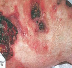 Mycosis Fungoides: patches, plaques