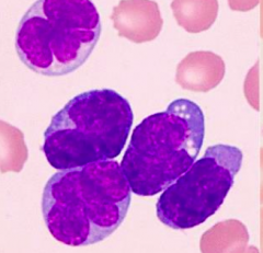 - "Flower cell" w/ lymphocytosis
- Hypercalcemia
- Aggressive