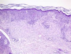 Skin bx showing papillary dermal edema and dense interstitial infiltrate of neutrophils involving the upper half of the reticular dermis.  Best dx?
Often associated w/ what malignancy?