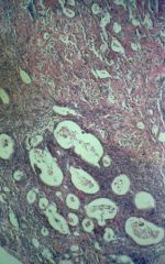 relatively small and uniform and found in sheets of malignant appearing cells with minimal cytoplasm and dark atypical nuclei
gland, nest, or cyst like cells