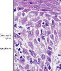 Spongiosis 
Seen in eczematous dermatoses:  contact dermatitis, nummular dermatitis, photoallergic dermatitis, atopic dermatitis