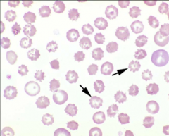 1. What spiculated RBC shape are these?
2. What is this shape diagnostic for?
3. Are polychromatic cells affected by rattlesnake envenomation?