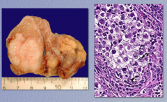 What is shown in the image? What are 50% of germ cell tumors? What is the histologic hallmark? 


 


What are 15% of germ cell tumors produce? 