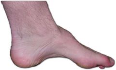 peroneal muscle atrophy (and tibial)

aut dom

clumbsy
pes cavus (high arch)
foot drop
claw hand (severe)

sural nerve biopsy is diagnostic

tx = stabilize ankles; surgical ankle fusion; phenytoin/carbamaz