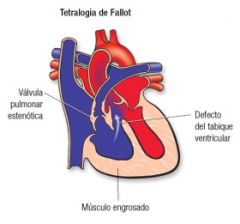 Tetralogia de Fallot - é cianogênica, pois tem mistura do sangue venoso e arterial por conta da aorta cavalgante; ficar de cócoras ( manobra de squatting) aumenta a RVP e diminui o shunt arteriovenoso, aliviando o paciente; criança, pois é u...