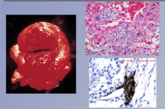 What is the tumor type? 


 


Only ___% of germ cell tumors are pure chorio, but chorio is commonly represented in mixed ______ cell tumors.

        Highly aggressive

        Mimics the histology of normal ______ (syncitiotropobla...