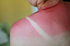 - Superficial cells of the epidermis are destroyed
- Skin is inflamed and tender
- e.g., sunburn