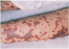 any organ: vasculitis and thromboembolic dis

meningococcal rash (black with ring of red)

high dose IV penicillin