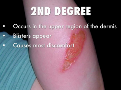 - Superficial and deeper cells of the epidermis are destroyed (dermis may be affected)
- Blisters on he skin and the burn is painful