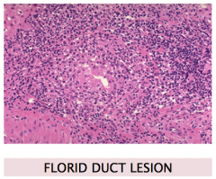distorted bile duct w/ inflammatory infiltrate