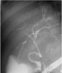 multifocal bile duct strictures & dilations