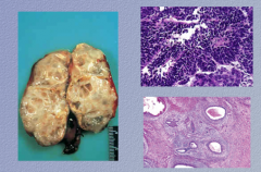 What is the tumor type? What type of tissue does it demonstrate? 