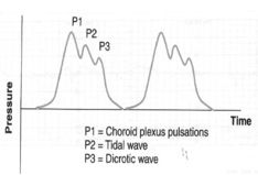 Interpretation of Waveforms

- High amplitude of 50-100mmHg sustained for 15 min (‘A waves’) – raised ICP
- Saw tooth with small changes in pressure every 0.5-2 minutes (‘B waves’) – poor intracranial compliance
- Low amplitude osc...