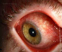 looks like pink eye but NOT

Bartonella henselae
Francisella tularensis
herpes simplex virus type 1
Paracoccidioides brasiliensis 