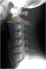A fracture of the C2 (axis) pars interarticularis as a result of hyperextension with or without axial loading, as in a motor vehicle accident (MVA).

Anterior movement (spondylolisthesis) of C2 results.