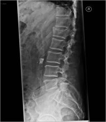 A fracture in which the bone collapses on itself, seen in vertebral fractures.