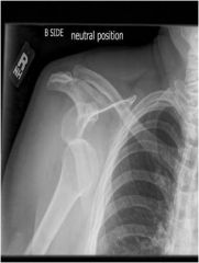 Typically occurs anterior and inferior. Caused by external rotation abduction force on humerus, or posterior to posterior-lateral blow.