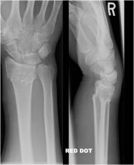 Distal radius fracture with dorsal displacement of the hand/wrist caused by a fall on outstretched arm.