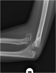 Dislocation of the radial head.