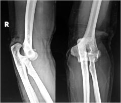 Usually caused by fall on the outstretched arm, most commonly resulting in posterior displacement of the olecranon to the humerus. Arm is shortened and held flexed.
