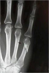Result of axial loading of the 4th and 5th metacarpal, as in hitting another person or hard object.