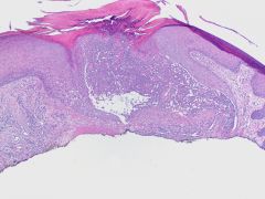 45-yo man with painful ulcerated lesion of the pinna of right ear.  Dx?