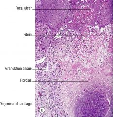 Chondrodermatitis nodularis chronica helicis
Hyperplasia of epidermis often w/ focal ulceration. Granulation tissue, fibrosis, solar elastosis, and mixed inflammatory infiltrate (lymphs, neuts, plasma cells) between ulcer and underlying cartilage...