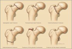 Most common in patients over 50 years of age.
Typically results from a fall.
Can involve femoral neck or trochanter.